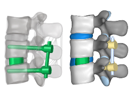 Az implantátumok digitalizált 3D modelljei virtuális műtét során 3D ágyéki gerincmodellekbe kerültek beültetésre